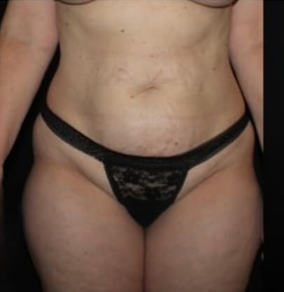 Tummy Tuck Before and After Gallery
