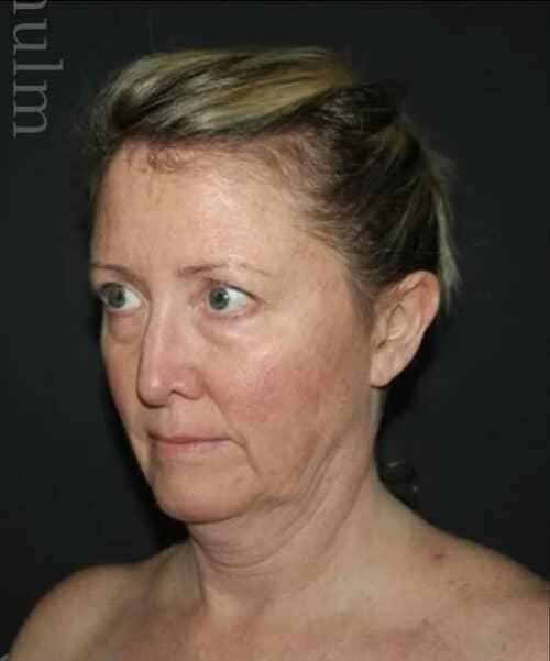 Face and Necklift Before and After Gallery