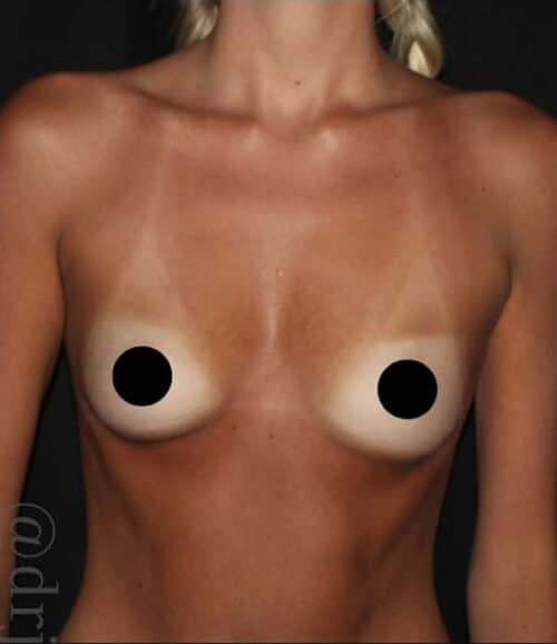 Breast Augmentation Before and After Gallery