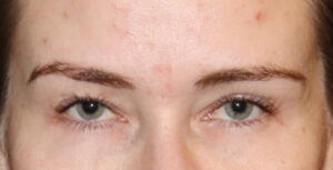 Eyelid Surgery Before and After Gallery
