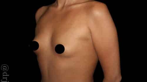Breast Augmentation Before and After Gallery