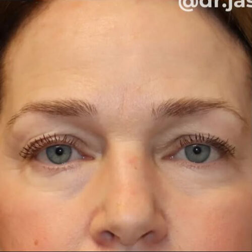 Eyelid Surgery Before and After Gallery