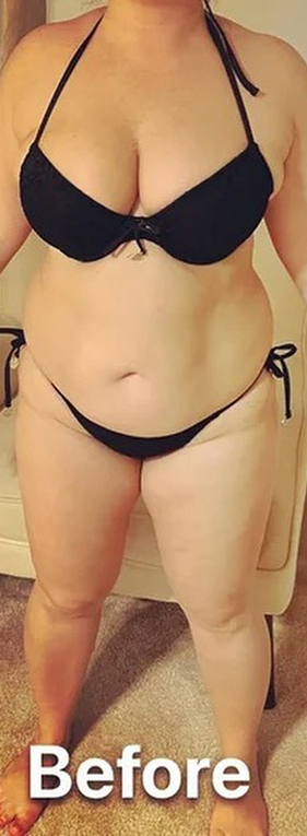 Liposuction Before and After Gallery