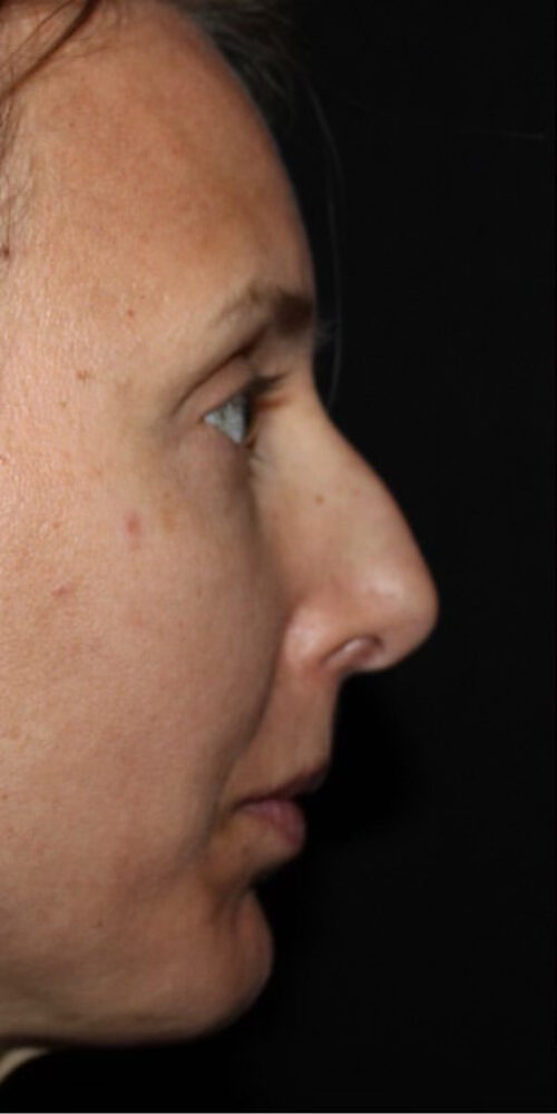 Rhinoplasty Before and After Gallery