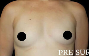 Breast Augmentation Before and After Gallery