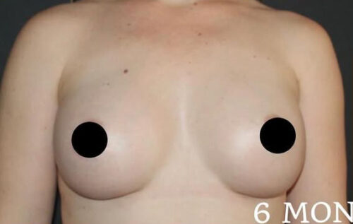 Breast Augmentation Before and After Gallery