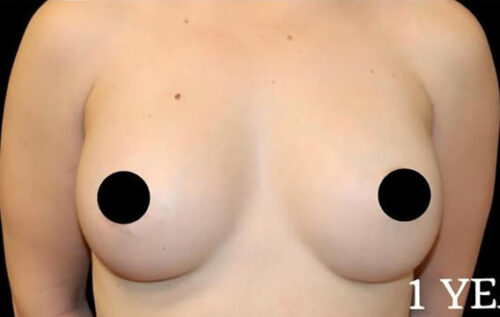 Breast Augmentation Before and After Gallery