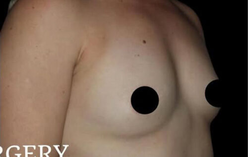 Breast Augmentation Before and After Gallery