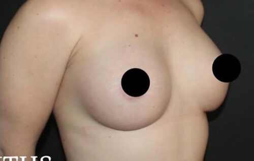 Breast Augmentation Before and After Gallery