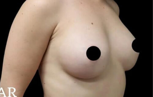 Breast Augmentation Before and After Gallery