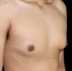 Gynecomastia Before and After Gallery