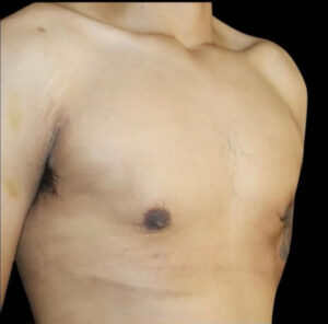 Gynecomastia Before and After Gallery