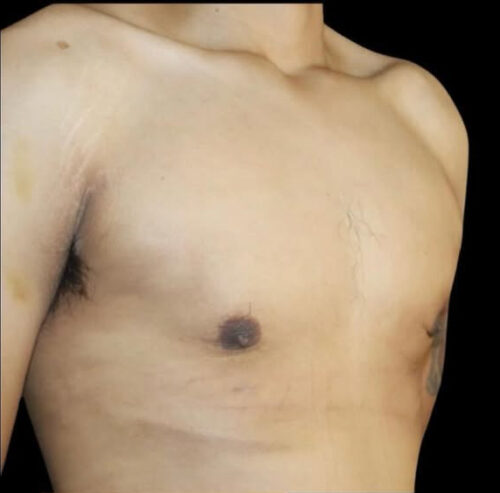 Gynecomastia Before and After Gallery