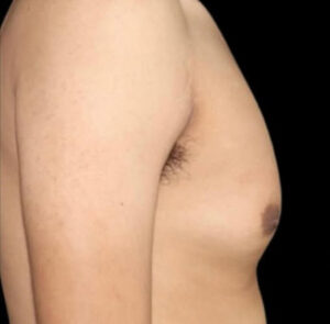 Gynecomastia Before and After Gallery