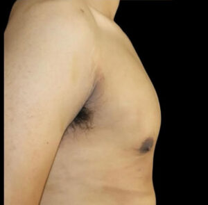 Gynecomastia Before and After Gallery