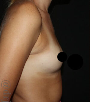 Breast Augmentation Before and After Gallery