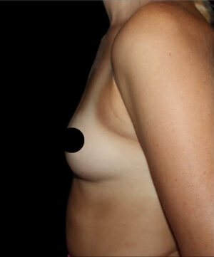 Breast Augmentation Before and After Gallery