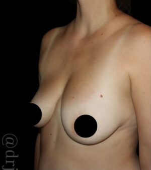 Breast Implants with Lift Before and After Gallery