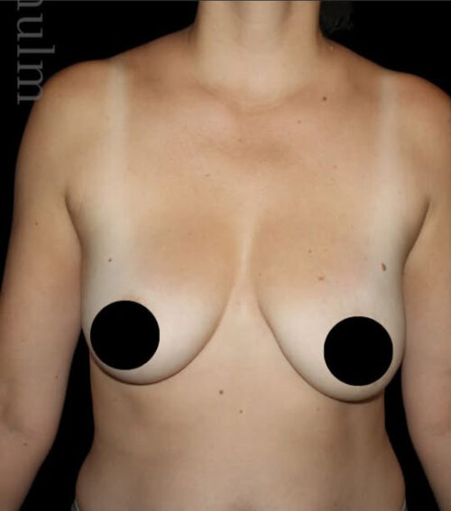 Breast Implants with Lift Before and After Gallery
