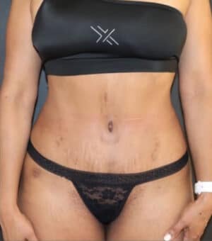 Tummy Tuck Before and After Gallery