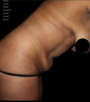 Tummy Tuck Before and After Gallery