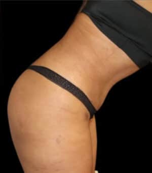 Tummy Tuck Before and After Gallery