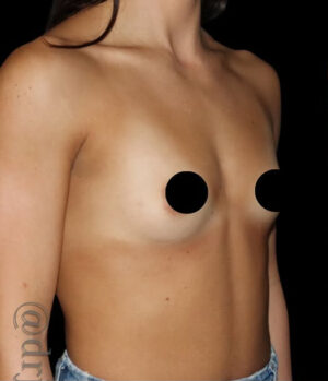 Breast Augmentation Before and After Gallery