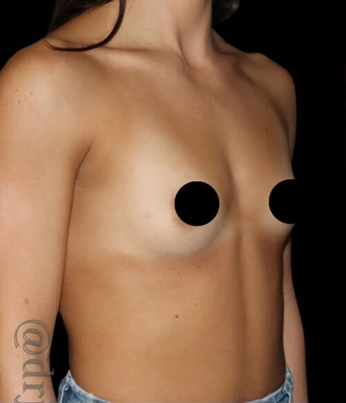 Breast Augmentation Before and After Gallery