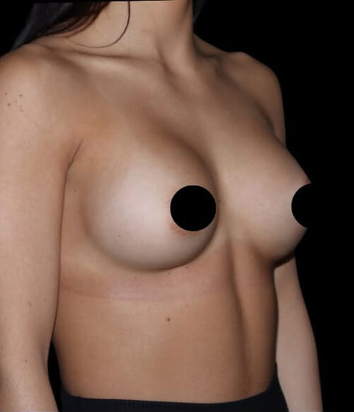 Breast Augmentation Before and After Gallery