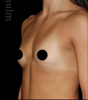 Breast Augmentation Before and After Gallery