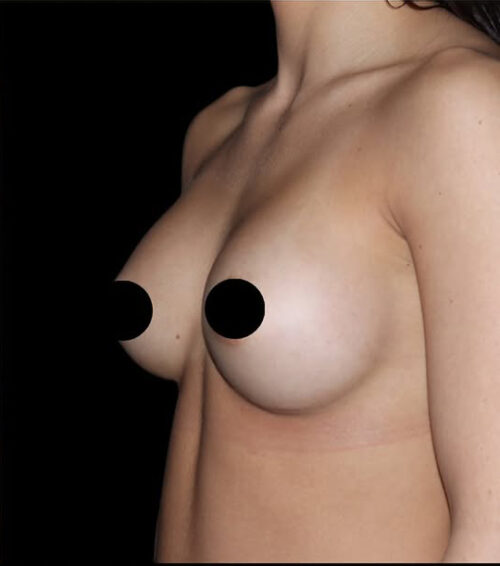 Breast Augmentation Before and After Gallery