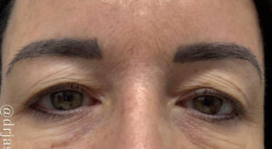 Eyelid Surgery Before and After Gallery
