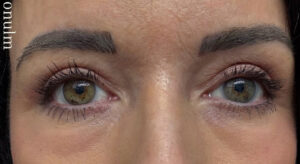 Eyelid Surgery Before and After Gallery