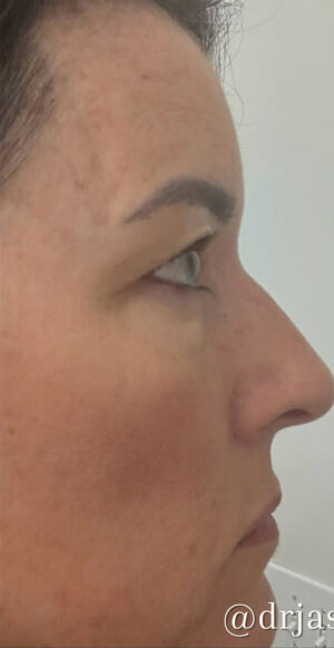 Eyelid Surgery Before and After Gallery