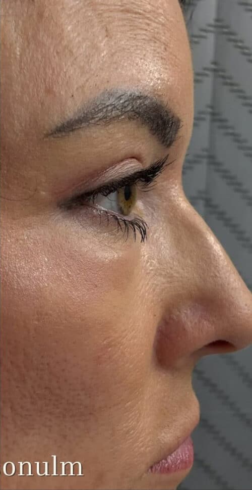 Eyelid Surgery Before and After Gallery