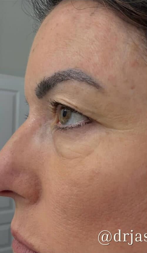Eyelid Surgery Before and After Gallery