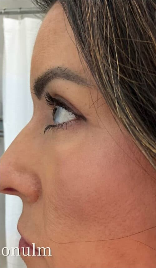 Eyelid Surgery Before and After Gallery