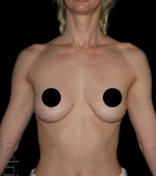 Breast Augmentation Before and After Gallery
