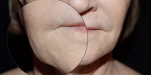 Face and Necklift Before and After Gallery