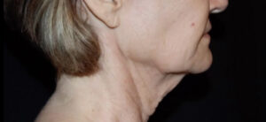 Face and Necklift Before and After Gallery