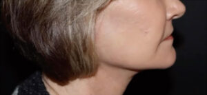 Face and Necklift Before and After Gallery
