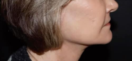Face and Necklift Before and After Gallery