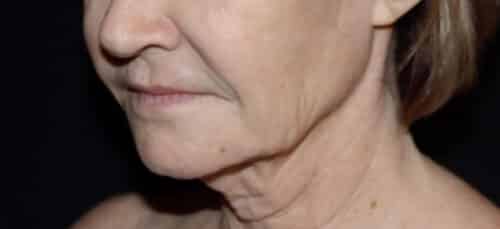Face and Necklift Before and After Gallery