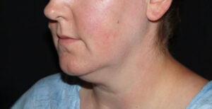 Submental Liposuction Before and After Gallery