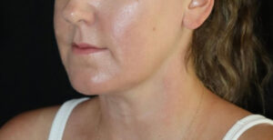 Submental Liposuction Before and After Gallery