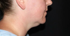 Submental Liposuction Before and After Gallery