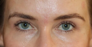 Eyelid Surgery Before and After Gallery
