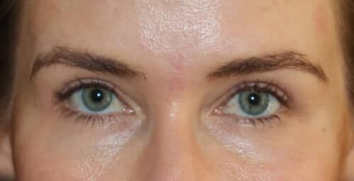 Eyelid Surgery Before and After Gallery