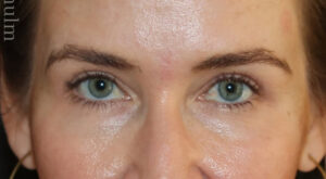 Eyelid Surgery Before and After Gallery