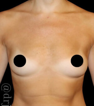 Breast Augmentation Before and After Gallery